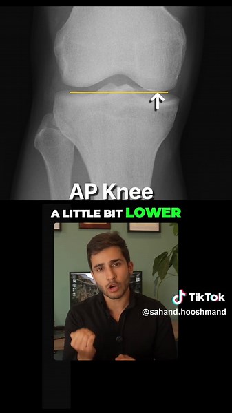Here’s part 2 of fixing your knee X-rays, where here I talk about what you need to do if your patient has a TKR (total knee replacements). In addition to that there’s the femoral sulcus sign, a very subtle one but this can also help you identify which condyle is which. #radiography #xray #medicalimaging #knee #positioning