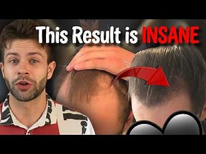 This is How These Reddit Users Finally Regrew Their Hair