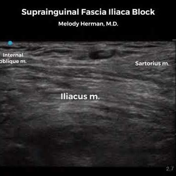 Suprainguinal Fascia Iliaca Block, OA-Regional Anesthesia Block of the Month, December 2024