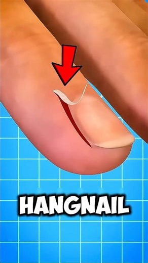 How to remove Hangnail in a safe way‼️