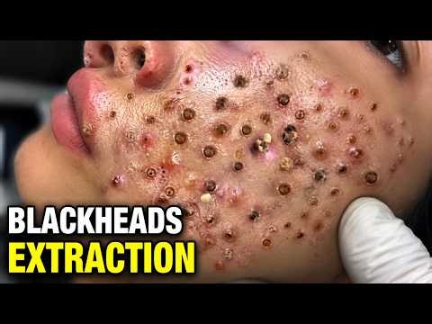 Blackheads Removal and Whitehead Removal for Deep Pore | ASMR | Remove Blackhead