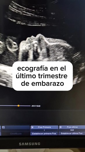 Ecografía en el tercer trimestre de embarazo: Evaluación del bienestar fetal
