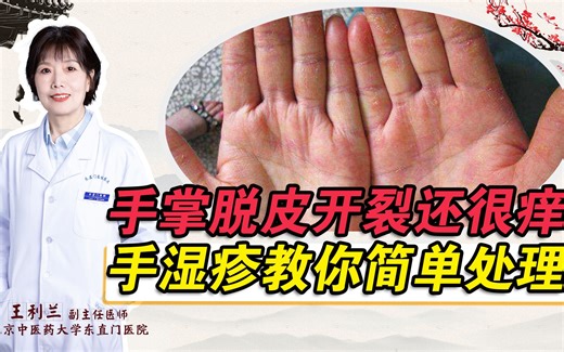手掌脱皮开裂还很痒 手湿疹教你简单处理