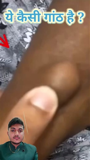 Lipoma #lipoma #lipomasurgery #tumor #fatlump