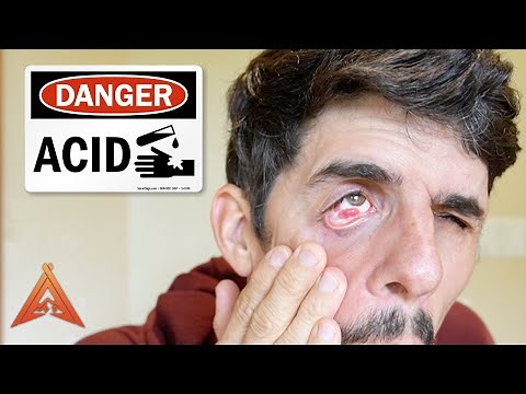 How Acid Destroyed My Eye