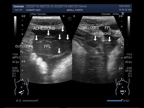 Ultrasound Video showing Sealed perforation with intestinal obstruction, and multiple adhesions.