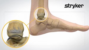 Ankle arthritis comes with: ⚫ Pain ⚫ Reduced ability to walk ⚫ Reduced ability to stand for long periods ⚫ Stiffness ⚫ Swelling Surgery may be recommended. But a fusion stops the ankle from moving, which can be hard to face. There is another option! With Stryker’s Total Ankle Replacements, the ankle can keep more of its ability to move and rotate. Stryker’s Total Ankle Replacements can: ⚫ Address the pain. ⚫ Maintain an active lifestyle. ⚫ Helps patients continue to walk normally. Stryker’s Tota