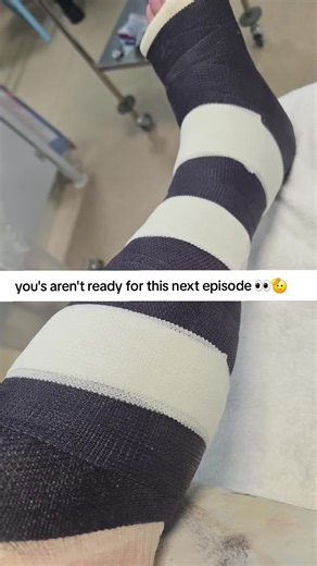 Journey Through Recovery: From Cast to Adventure