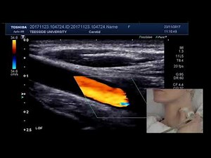 How to scan the carotid arteries