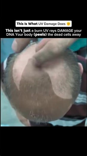 Your Sunburn Is DNA Damage