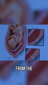 #PlacentaAccreta: A condition where the placenta grows too deeply into the uterine wall, posing serious risks during pregnancy.擄 Dr. Robert Feldman, OB-GYN Chief at Baptist Health South Florida, breaks down the complexities of placental conditions and their impact on pregnancy. | Allhealthgo | Facebook