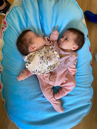 🥰The doctors successfully separated conjoined twins who were connected at the chest. Three years later, they are healthy, thriving, and leading independent lives.❤️ A remarkable medical breakthrough. In a small town in Northern Ireland, a family had been waiting for a miracle that seemed distant for many years. After struggling with infertility for years, their dream was finally coming true — twin girls were on the way! 👶👶✨ But soon, joy was mixed with concern. The doctors delivered shocking 