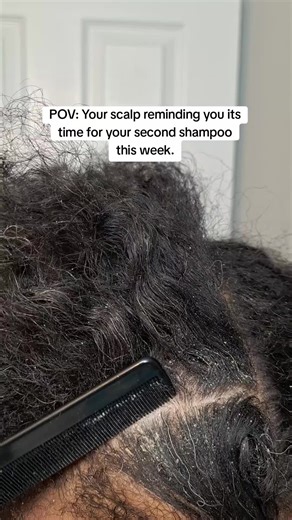 Managing Seborrheic Dermatitis: Scalp Care Tips