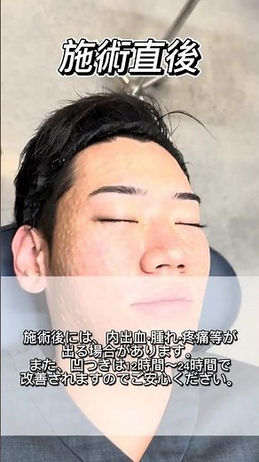 内出血ゼロでダウンタイム最小限！【リジュランSと女優注射の施術動画】#女優注射 #リジュラン #湘南美容クリニック
