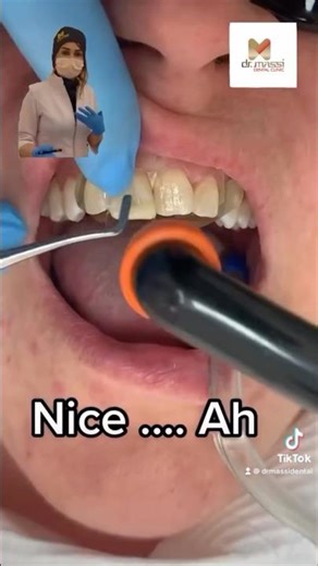 FRONT TEETH RESTORATION 🦷