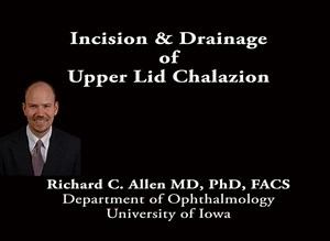 Incision & Drainage of Upper Lid Chalazion
