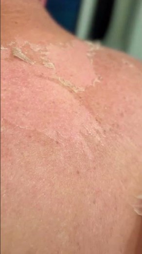 Skin peel after sunburn