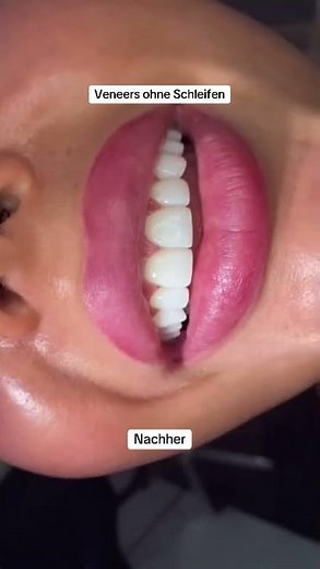 Hollywood Smile 💎 | FIT Veneers ohne Schleifen