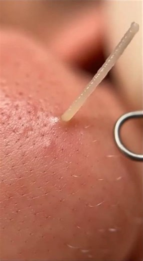 INSANE 5cm Sebum Thread Extraction | Extreme Macro Skincare