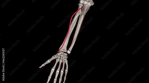 The radial artery is one branch of the brachial artery, a major blood vessel in the upper arm .