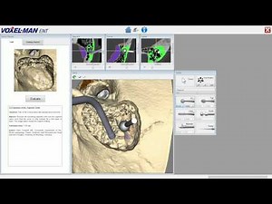 Exposure of the Sigmoid Sinus with Voxel-Man Tempo