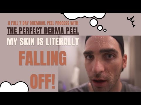 INSANE Chemical Peel Before And After! Explaining What A Perfect Derma Peel Even Is!