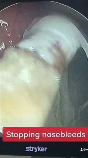 Cauterization with silver nitrate to stop nosebleeds (epistaxis)