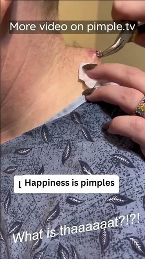 The best pimples, hands down
