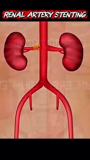 Renal Artery Procedure to Treat Blockages