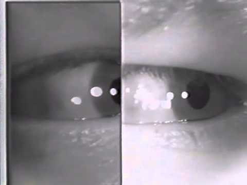 Abducting (Dissociated) Nystagmus