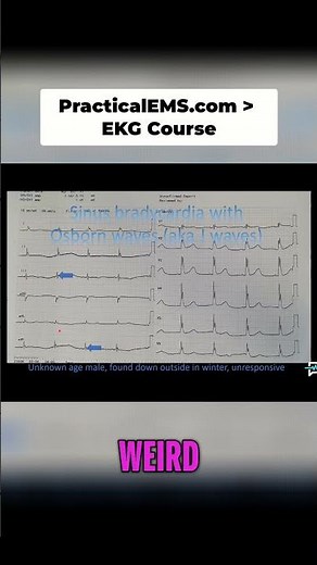 Understanding Sinus Bradycardia: Osborn Waves Explained