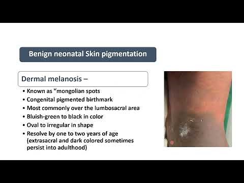 Mongolian Spots | Spot Diagnosis 29 | Pediatrics