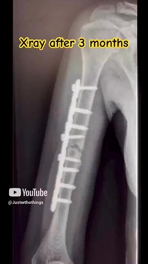 148K views · 553 reactions | Humerus Fracture: Radiographs  #ortho #trauma #fracture | Just Ortho Things | Facebook