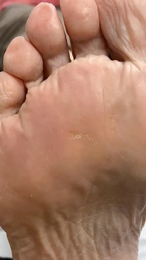 Ditch the discomfort now! Learn how to remove a seed corn from your forefoot. . . . #footpain #plantarfasciitis #heelpain #podiatry #footcare #podiatrist #orthotics #feet #foothealth #kneepain #foot #running #anklepain #backpain #bunions #flatfeet #healthyfeet #footpainrelief #arthritis #health #footdoctor #bunion #fyp #foryou #viralreels #explore | Docpods Treatment