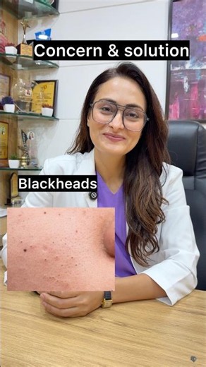 Blackheads, whiteheads, acne marks, dull skin