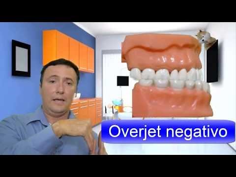 Oclusión Overjet