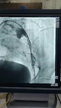 Catheter Directed Thrombolysis of Deep Vein Thrombosis (DVT)