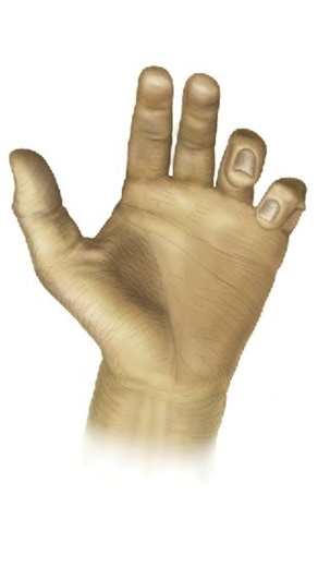 Masse Sign evaluates for ulnar neuropathy. The examiner observes both hands of the patient, comparing the affected and unaffected hand. Positive findings include palmar arch flattening, loss of ulnar hand elevation, and loss of hypothenar bulk. Diagnostic accuracy is unknown. 🔗👇 Link Below 👇🔗 -- Read: https://wikism.org/Masse_Sign -- Watch: https://www.youtube.com/watch?v=C5kWoXrGDRk -- #MedicalEducation #MedEd #Physio #ATC #Orthopedics #SportsMedicine #PhysicalTherapy #AthleticTraining #Reh