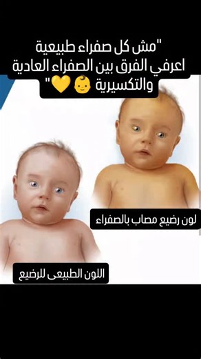 Supermate Doula on Instagram‎: "🌞 الصفراء التكسيرية... لما الجسم يهاجم كرات دمه بنفسه! الصفراء التكسيرية (أو اليرقان التكسيري / الانحلالي) هي نوع من الصفراء (اليرقان) بيحصل نتيجة تكسير كرات الدم الحمراء بشكل أسرع من الطبيعي، وده بيؤدي إلى زيادة مادة البيليروبين في الدم — وهي المادة اللي بتسبب اللون الأصفر في الجلد والعينين. --- 💛 الأسباب: عدم توافق فصيلة الدم بين الأم والطفل (زي Rh incompatibility أو ABO incompatibility). أنيميا الفول (G6PD deficiency) عند الطفل. تكسر كرات الدم بسبب عدوى أو بع