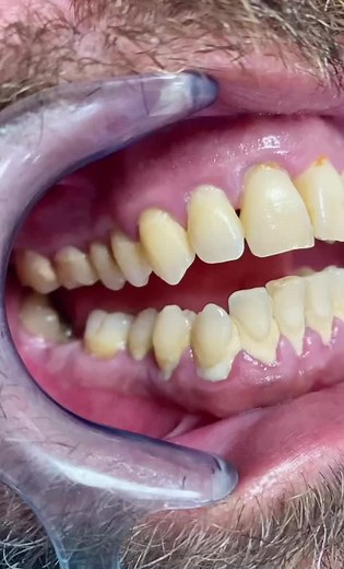Tratamiento Periodontal: Antes y Después