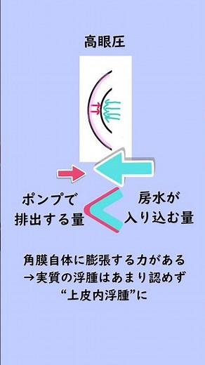 Why Does High Eye Pressure Blur Your Vision? Explaining the Mechanism of Corneal Edema