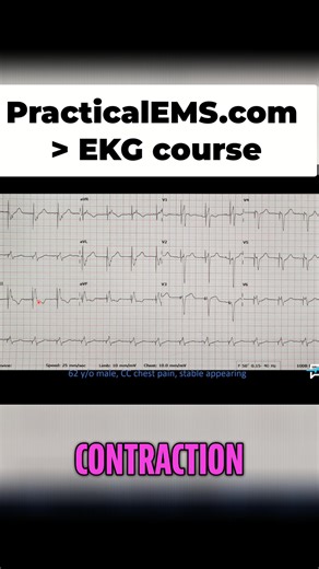This video introduces pacer spikes, a new component you might see on an EKG. They're usually pretty obvious, but some monitors can make them less so. Learn to identify them and what they mean in this quick guide. #EKG #PacerSpikes #VentricularPaced #HeartRhythm #MedicalEducation | Practical EMS
