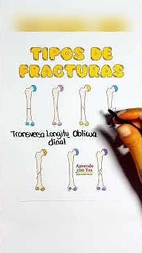 Fracture classification
