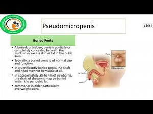 Micropenis and Delayed Puberty: A Comprehensive Approach to Diagnosis and Treatment, Prof Jamal Raza