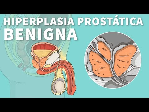 Hiperplasia prostática benigna: Causas, síntomas y tratamiento (HPB) | Stanford