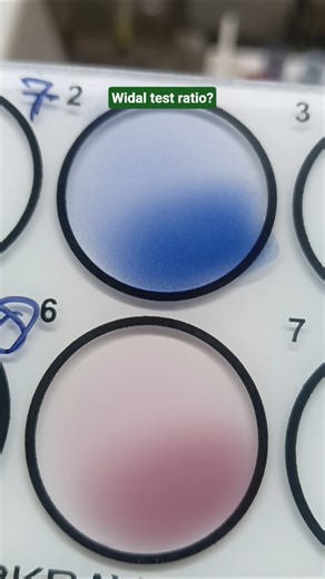 Widal test ratio? #labtechnician #lab #pathology #laboratory #nurse #dmlt #nursing #doctor #shorts