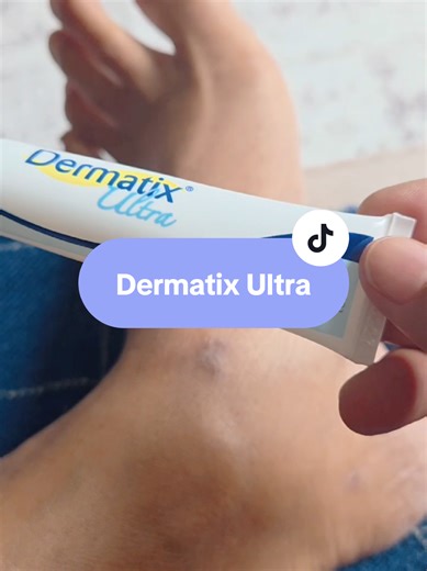 Transforming My Scar with Dermatix Ultra