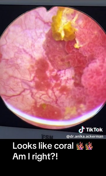 Scraping out a large bladder tumor #bladdercancer #urology #urologist #surgery #surgeon #operatingroom