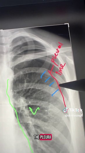 How to Spot a Pneumothorax on Chest X-Ray