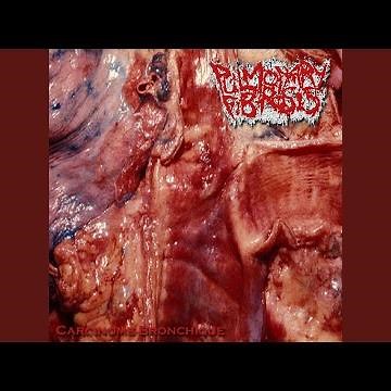 Process of Metastasis